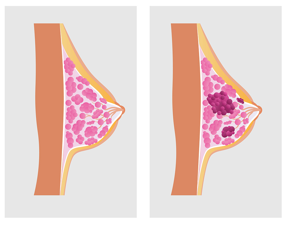 breast cancer anatomy - zanfaraz.com - sientific view - سرطان سینه