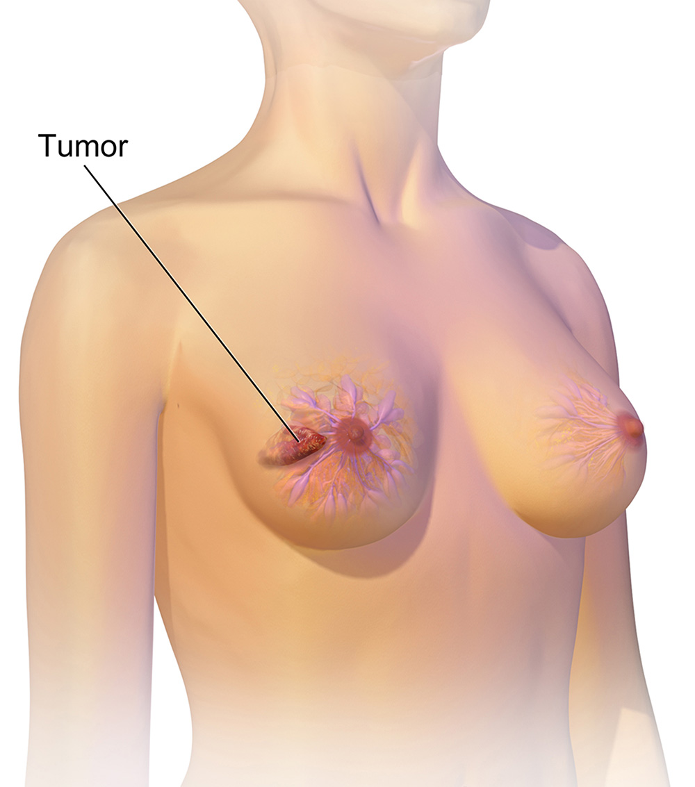female-breast-tumor-zanfaraz